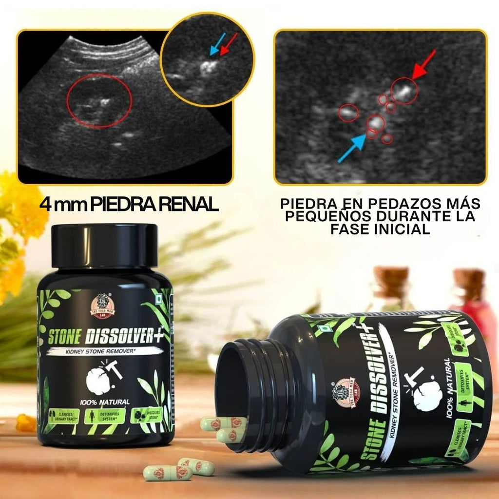 STONE DISSOLVER – La Fórmula Natural Que Disuelve Cálculos Renales y Vesiculares 🌿
