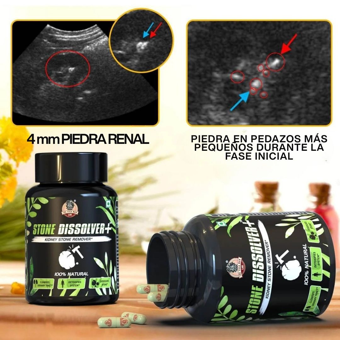 STONE DISSOLVER – La Fórmula Natural Que Disuelve Cálculos Renales y Vesiculares 🌿