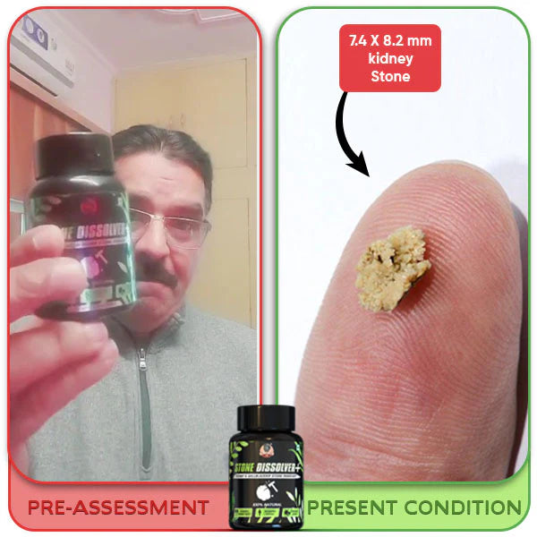 STONE DISSOLVER – La Fórmula Natural Que Disuelve Cálculos Renales y Vesiculares 🌿