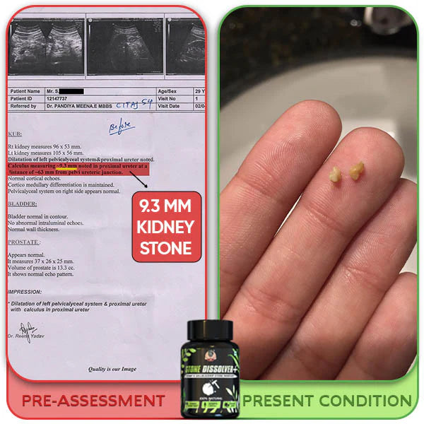 STONE DISSOLVER – La Fórmula Natural Que Disuelve Cálculos Renales y Vesiculares 🌿
